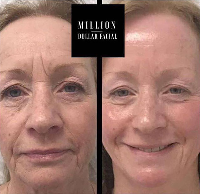 Aqua Beauty Salon Dublin Million Dollar Facial